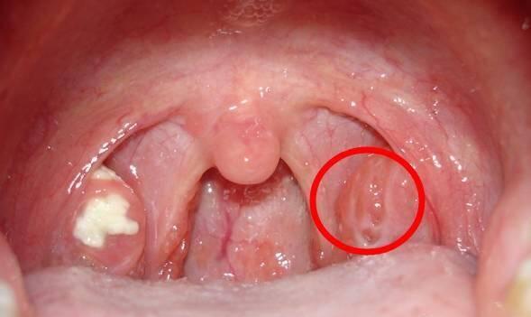 扁桃腺图片,扁桃腺解剖与功能解析图鉴